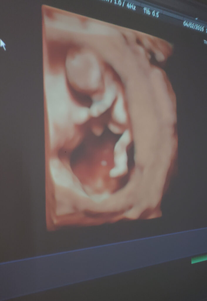 Gender 13 ultrasound at weeks How to